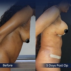 Before and after tummy tuck results at Dr. Safa Manav Clinic, visible abdominal contour change