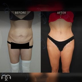 Before and after tummy tuck results at Dr. Safa Manav Clinic, visible abdominal contouring