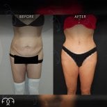 Before and after tummy tuck results at Dr. Safa Manav Clinic, visible abdominal contouring