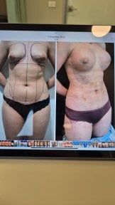 Результати до і після контурної пластики тіла та підтяжки грудей у Memorial Şişli Hospital