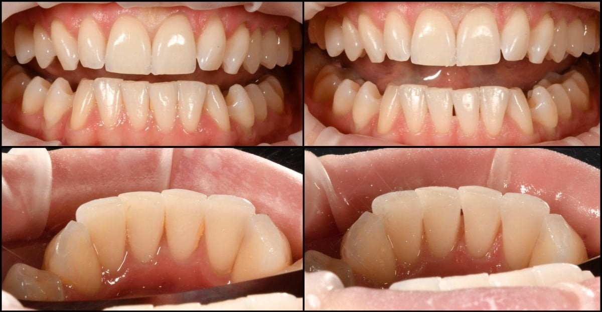 نتائج قبل وبعد تنظيف الأسنان (تقشير) في عيادة RIKOTA Dental Clinic، تحسين صحة الفم