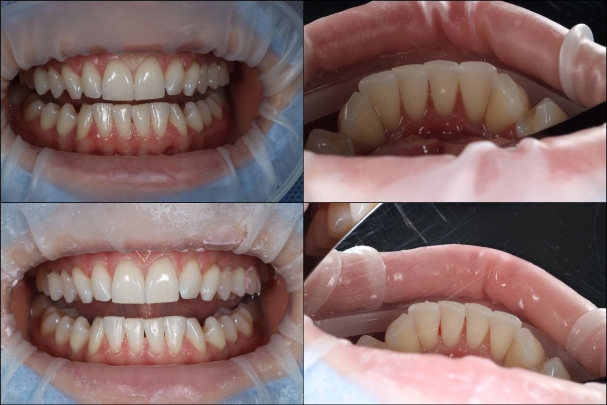 نتائج قبل وبعد تنظيف الأسنان (إزالة الجير) في RIKOTA Dental Clinic، تحسين صحة الفم
