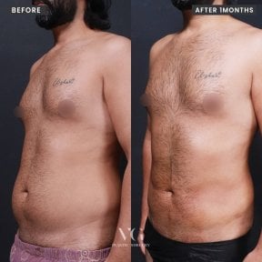 Результаты абдоминальной липосакции до и после в VG Plastic Surgery, улучшенный контур тела