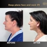 Before and after mini facelift results at ID Clinic Bangkok – visible facial and neck lift improvement