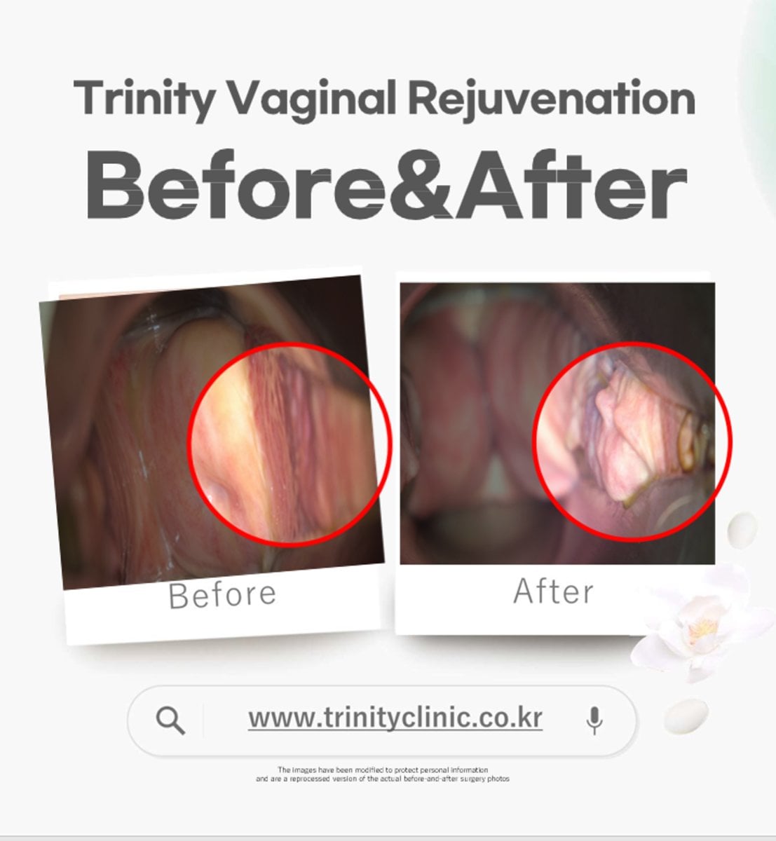 نتائج تجديد المهبل بالليزر قبل وبعد في عيادة Trinity Women's Clinic، تحسين مرونة الأنسجة