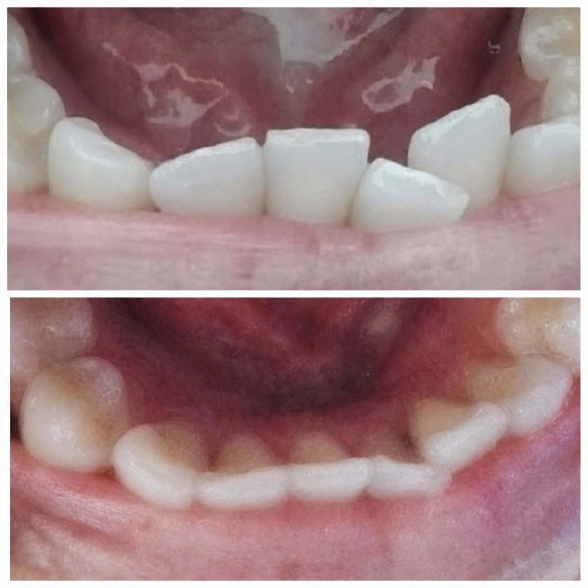 Resultados antes y después de brackets en Love Dental and Sthetic Clinic, alineación dental