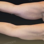 Vorher-nachher-Ergebnis Armlifting bei Memorial Göztepe Hospital, verbesserte Kontur