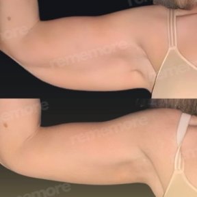 Vorher-nachher-Ergebnis der Armlifting-OP in Memorial Göztepe Hospital, verbesserte Kontur