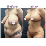 Before and after breast reduction and tummy tuck results at Db'est Clinic, body contour improved