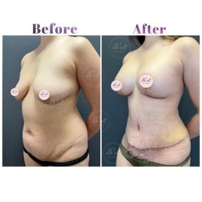 Before and after breast reduction and tummy tuck results at Db'est Clinic, body contour improved