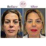 Blepharoplastik Vorher-Nachher-Ergebnis bei Db'est Clinic – Lidkorrektur und Verjüngung