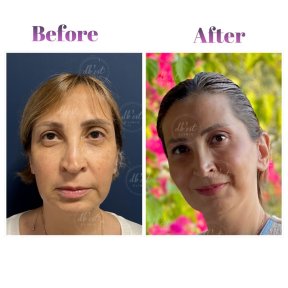 Vorher-nachher-Ergebnis der Blepharoplastik bei Db'est Clinic, Lidkorrektur für jüngeres Aussehen