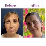 Vorher-nachher-Ergebnis der Blepharoplastik bei Db'est Clinic, Lidkorrektur für jüngeres Aussehen