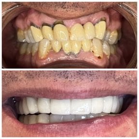 نتيجة قبل وبعد زراعة الأسنان All-on-4 في Dental Bosphorus، استعادة الابتسامة