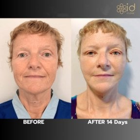Before and after deep plane facelift results at ID Clinic Bangkok, visible facial rejuvenation
