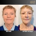 Before and after deep plane facelift results at ID Clinic Bangkok, visible facial rejuvenation