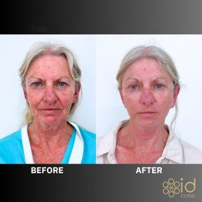 Before and after upper and lower eyelid surgery results at ID Clinic Bangkok, rejuvenated look