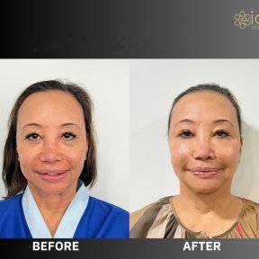 Before and after upper and lower eyelid surgery results at ID Clinic Bangkok, rejuvenated look