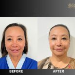Before and after upper and lower eyelid surgery results at ID Clinic Bangkok, rejuvenated look