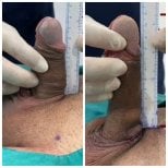 Before and after surgical penile lengthening results at Eternity Clinic Pleonchit, increased length