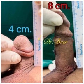 Before and after surgical penile lengthening results at Eternity Clinic Pleonchit, increased length