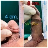 Before and after surgical penile lengthening results at Eternity Clinic Pleonchit, increased length