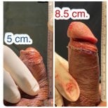 Before and after surgical penile lengthening results at Eternity Clinic Pleonchit, increased length