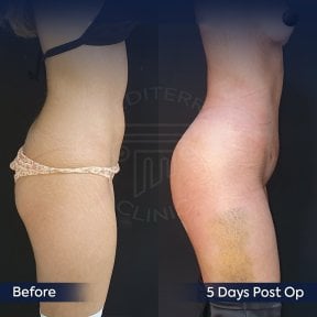 Before and after Brazilian Butt Lift results at Dr. Safa Manav Clinic, enhanced curves visible