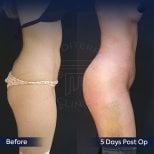Before and after Brazilian Butt Lift results at Dr. Safa Manav Clinic, enhanced curves visible