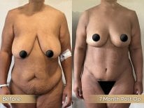 Результаты до и после абдоминопластики и липосакции в клинике Dr. Safa Manav, 7 месяцев
