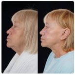 Before and after chin liposuction results at Yurchenko Plastic Surgery Team, improved jawline