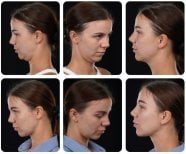 Before and after chin liposuction results at Yurchenko Plastic Surgery Team, improved jawline