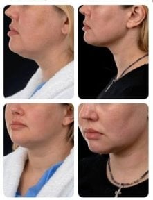 Before and after chin liposuction results at Yurchenko Plastic Surgery Team, improved jawline