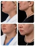 Before and after chin liposuction results at Yurchenko Plastic Surgery Team, improved jawline