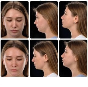 Before and after chin liposuction results at Yurchenko Plastic Surgery Team, improved jawline