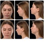 Before and after chin liposuction results at Yurchenko Plastic Surgery Team, improved jawline
