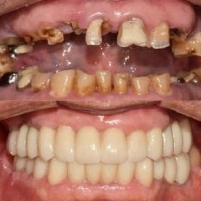 Before and after dental implant results at 365SeoulOneTop365 Dental Clinic, full smile restoration