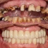 Before and after dental implant results at 365SeoulOneTop365 Dental Clinic, full smile restoration