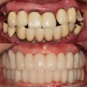 Before and after dental implant results at 365SeoulOneTop365 Dental Clinic, restored smile