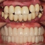 Before and after dental implant results at 365SeoulOneTop365 Dental Clinic, restored smile