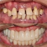 Before and after dental implant results at 365SeoulOneTop365 Dental Clinic, restored smile