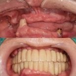 Before and after dental implant results at 365SeoulOneTop365 Dental Clinic, full mouth restoration