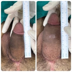 Resultados antes y después de relleno de pene en Eternity Clinic Phuket By Dr.Beer, mejora visible