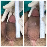 Resultados antes y después de relleno de pene en Eternity Clinic Phuket By Dr.Beer, mejora visible