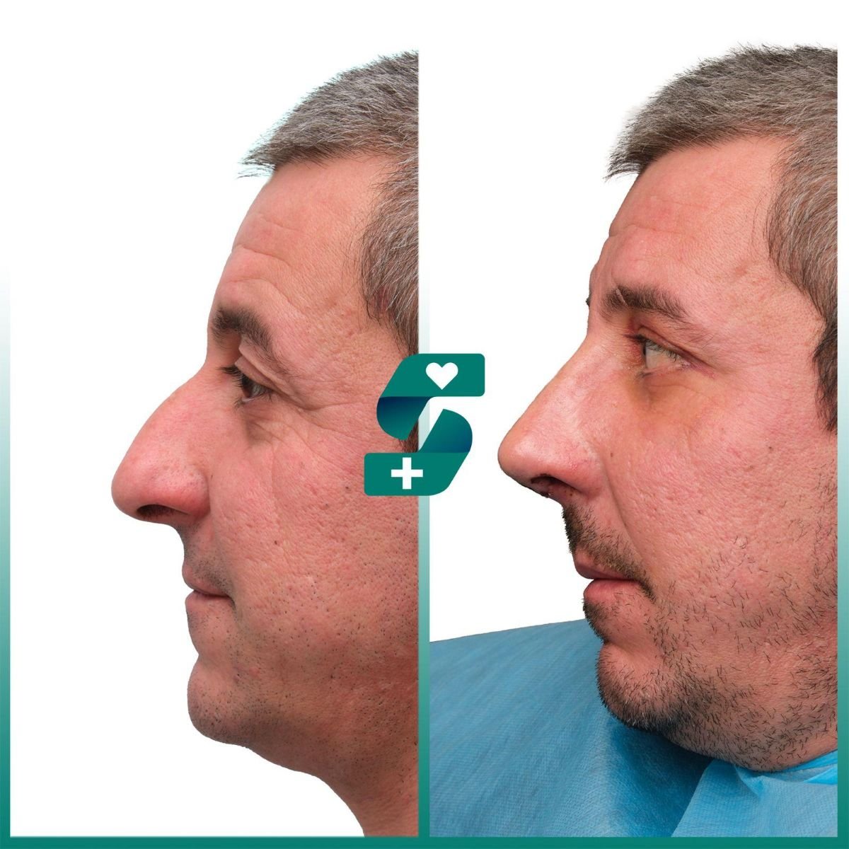 Resultado de rinoplastia antes y después en Soraca Med, mejora de forma y perfil nasal