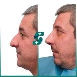 Resultado de rinoplastia antes y después en Soraca Med, mejora de forma y perfil nasal