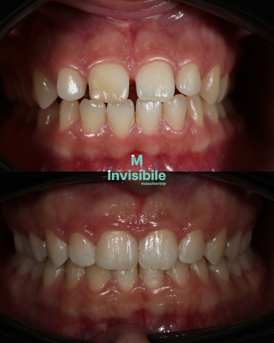 Resultados antes y después de Invisalign en Grand Dental Hospital & Laboratory, mejora de alineación dental