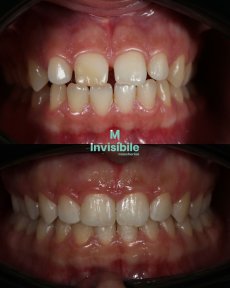 Before and after Invisalign results at Grand Dental Hospital & Laboratory, teeth alignment improvement