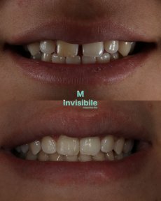Before and after Invisalign results at Grand Dental Hospital & Laboratory, teeth alignment improvement