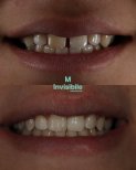 Before and after Invisalign results at Grand Dental Hospital & Laboratory, teeth alignment improvement